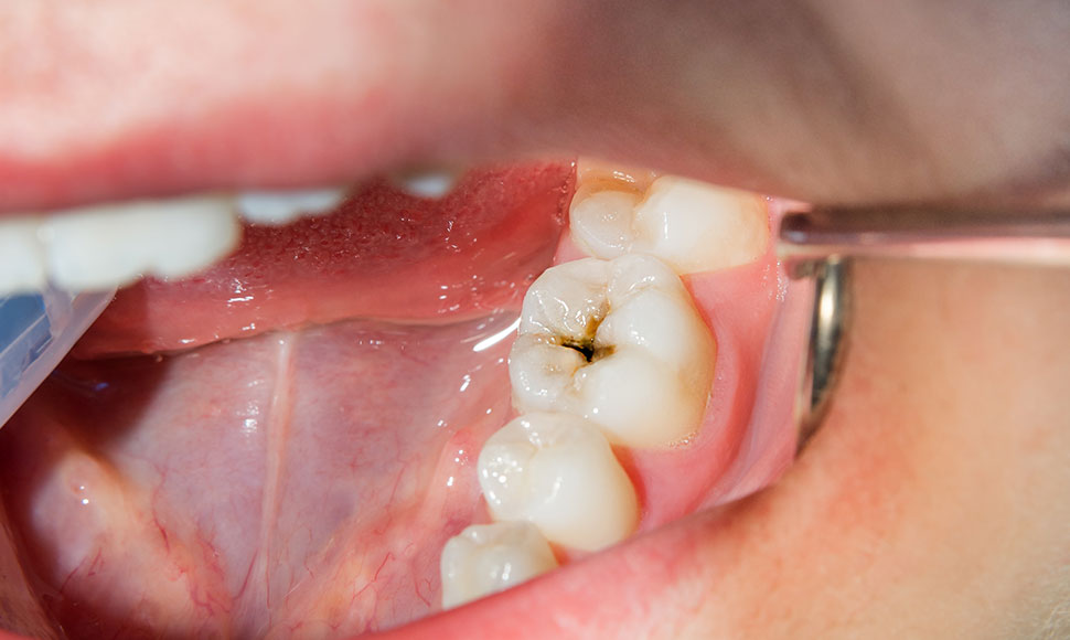 もりかわ歯科クリニックの虫歯治療