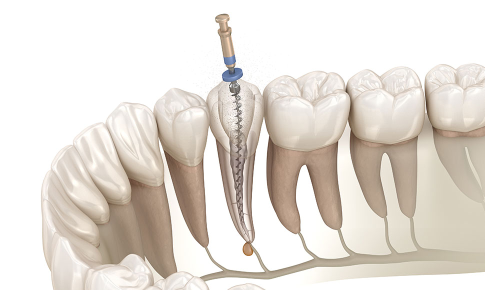 虫歯が進行すると、歯の神経にまで感染が起こり、強い痛みや腫れをともないます。