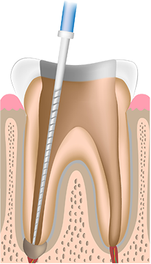 虫歯と歯髄の除去 洗浄・消毒