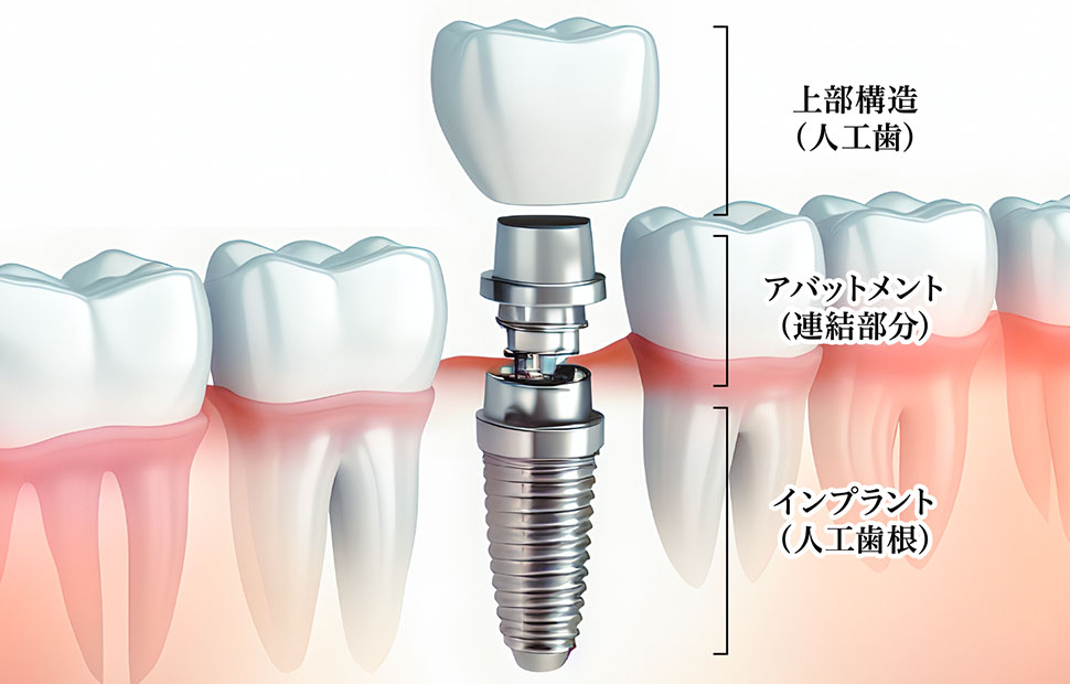 歯科用インプラントの基本構造