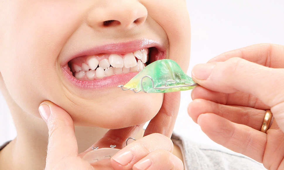 乳歯から永久歯へ生え替わる時期から始める矯正