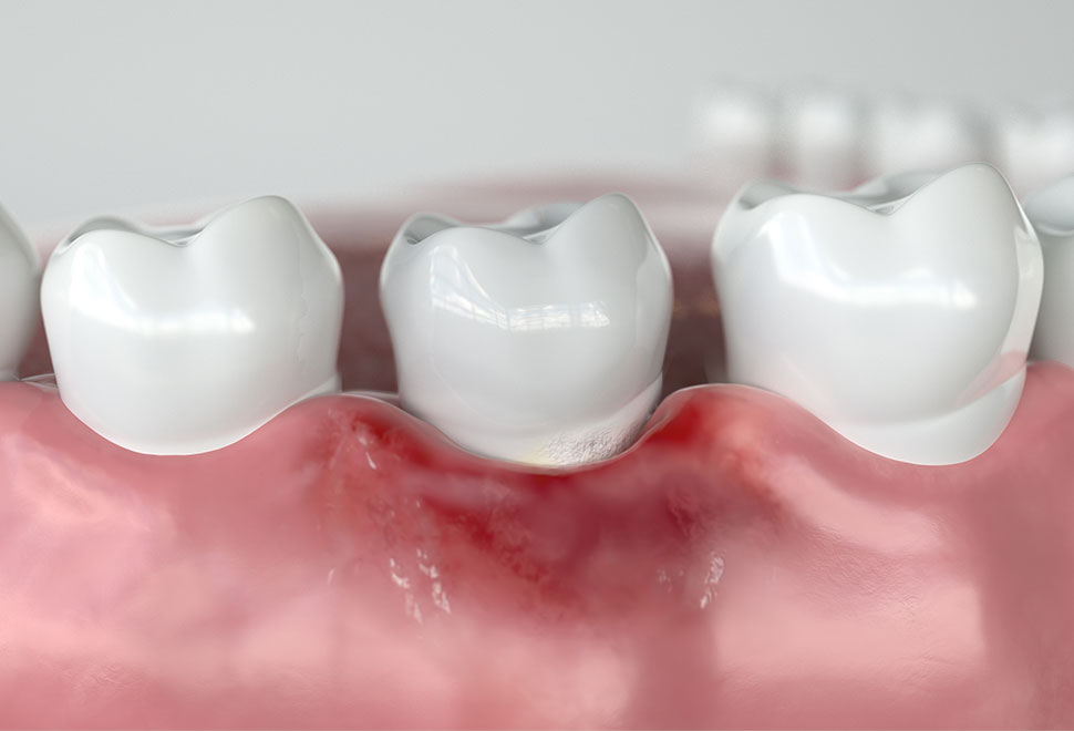 歯周病は、歯槽骨（歯を支える骨）や歯肉などの歯周組織に炎症が起こる病気です